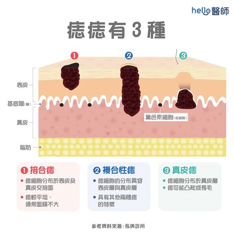 脖子痣長毛|痣形成的原因？痣長毛、痣變多變大是痣病變？5招判。